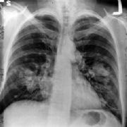 Patientforening vil starte lokalafdeling