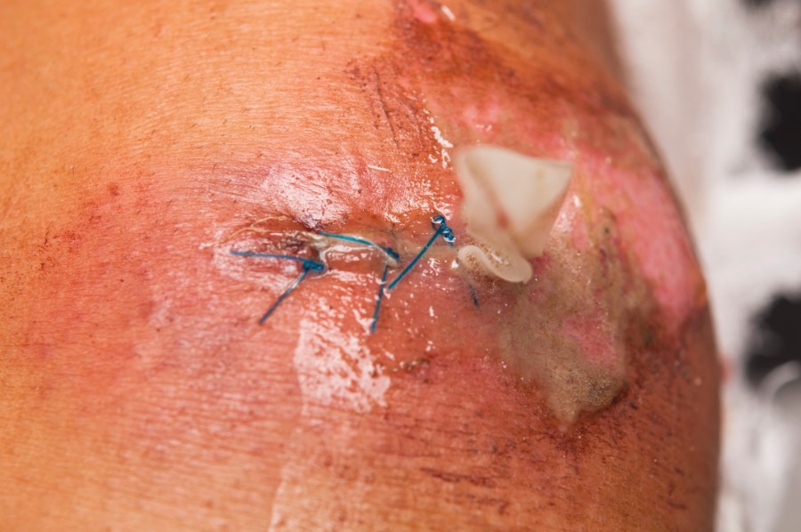 S�ret skal rensens grundigt